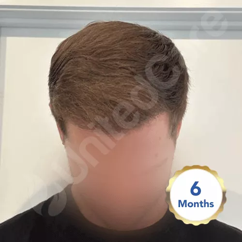 unitedcare hair transplant after