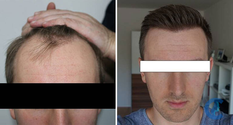 ozgur oztan before after