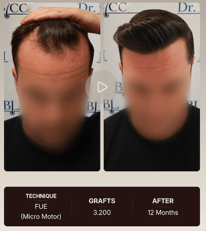 ozlem bicer before after